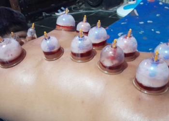 8 Manfaat Bekam, Bisa Menyedot Racun dan Menyerap Angin Duduk