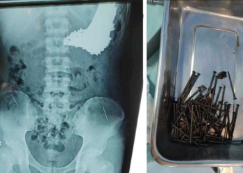 70 Batang Paku Bersarang di Lambung Warga Indramayu