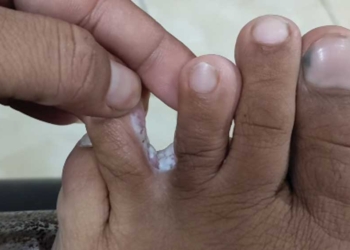 8 Cara Mengobati Kutu Air