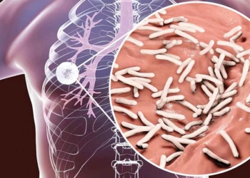 Kasus TBC di Kabupaten Cirebon masih Tinggi