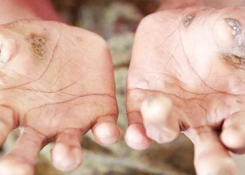 177 Warga di Kabupaten Cirebon Penderita Kusta, Bisa Sembuh, Dinkes Imbau Masyarakat Jangan Kucilkan